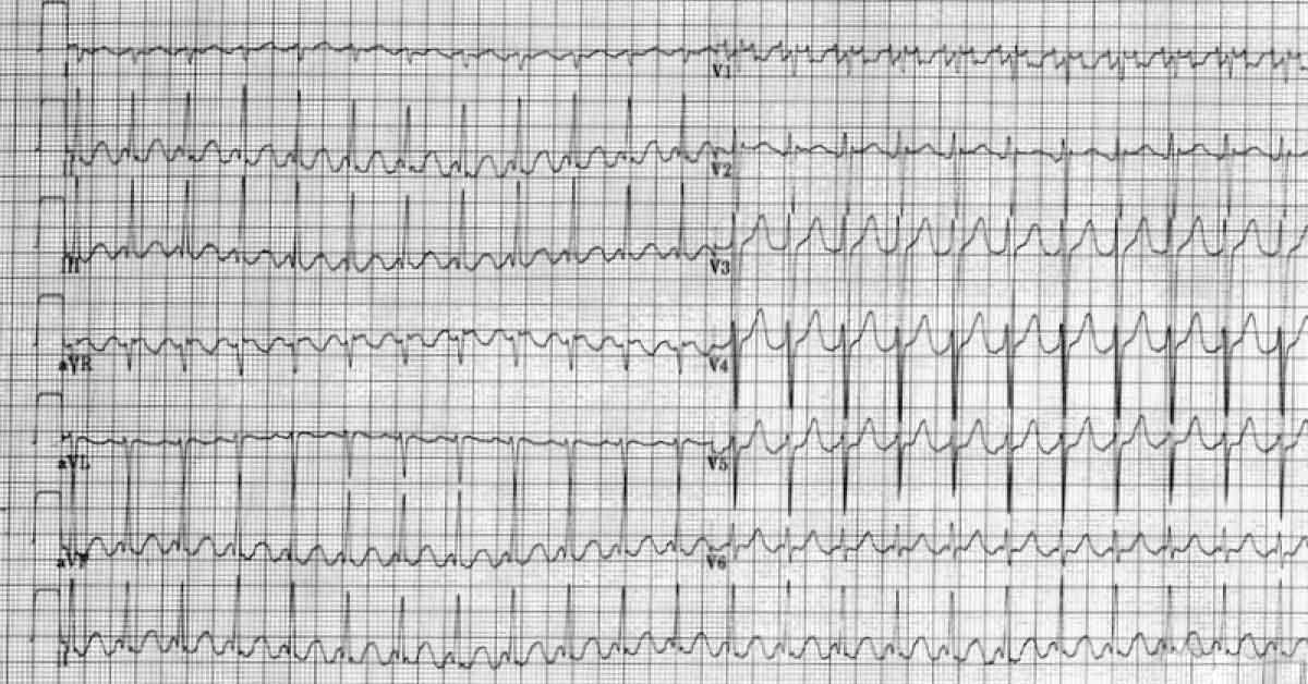 Identify This Condition From Attached ECG Only