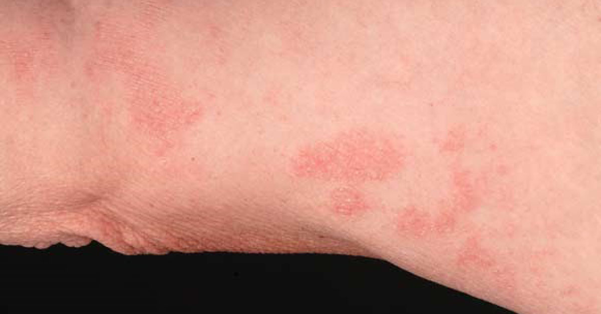 Spot This Dermatological Condition