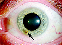 Brief Review On Ocular Manifestations Of Smoking