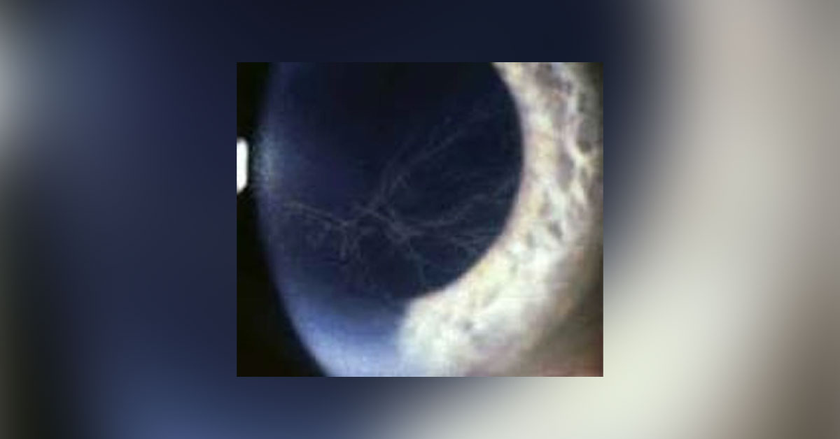 Cornea Verticillata Or Vertex Keratopathy A Brief Review
