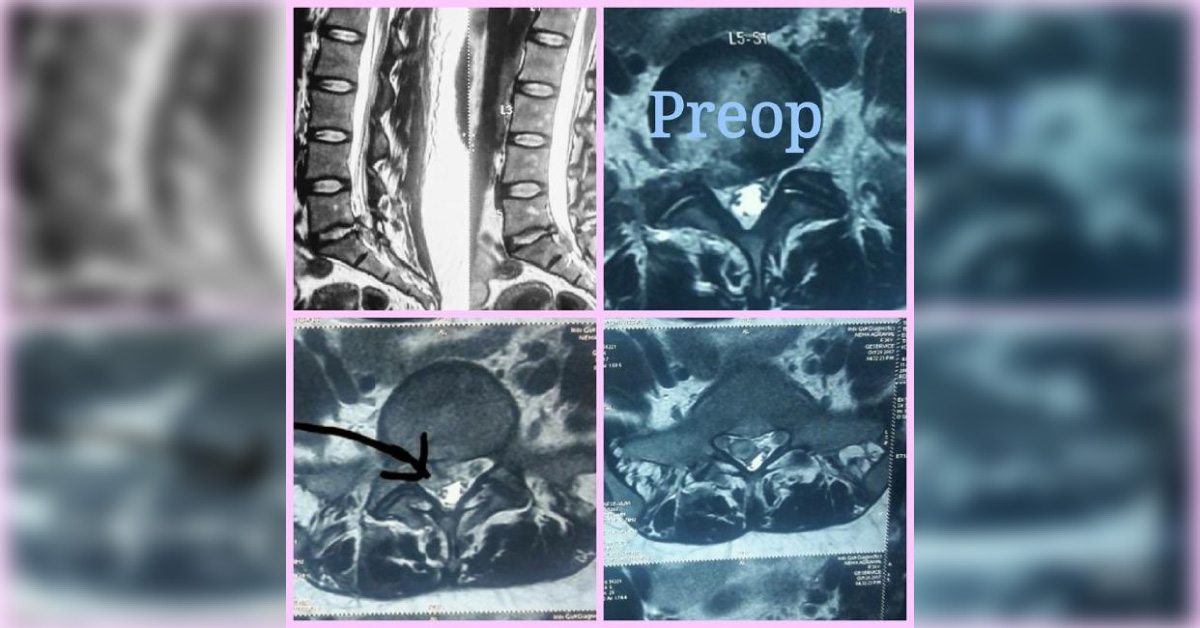Percutaneous Endoscopic Interlaminar Lumbar Disc Decompression Of Inferiorly Migrated L5-S1 Disc