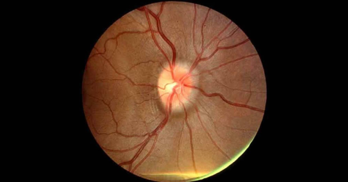 Idiopathic Intracranial Hypertension A Brief Review