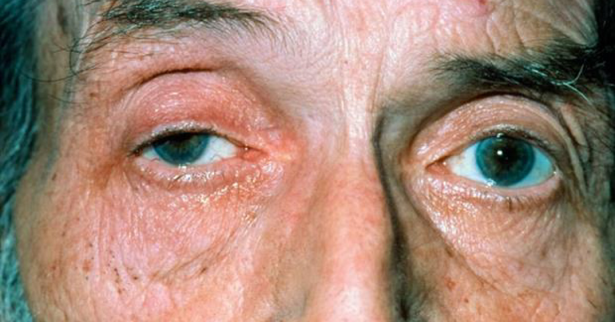 Ocular Manifestations Of Brain Tumors A Brief Review