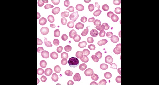 Interpret The Blood Film