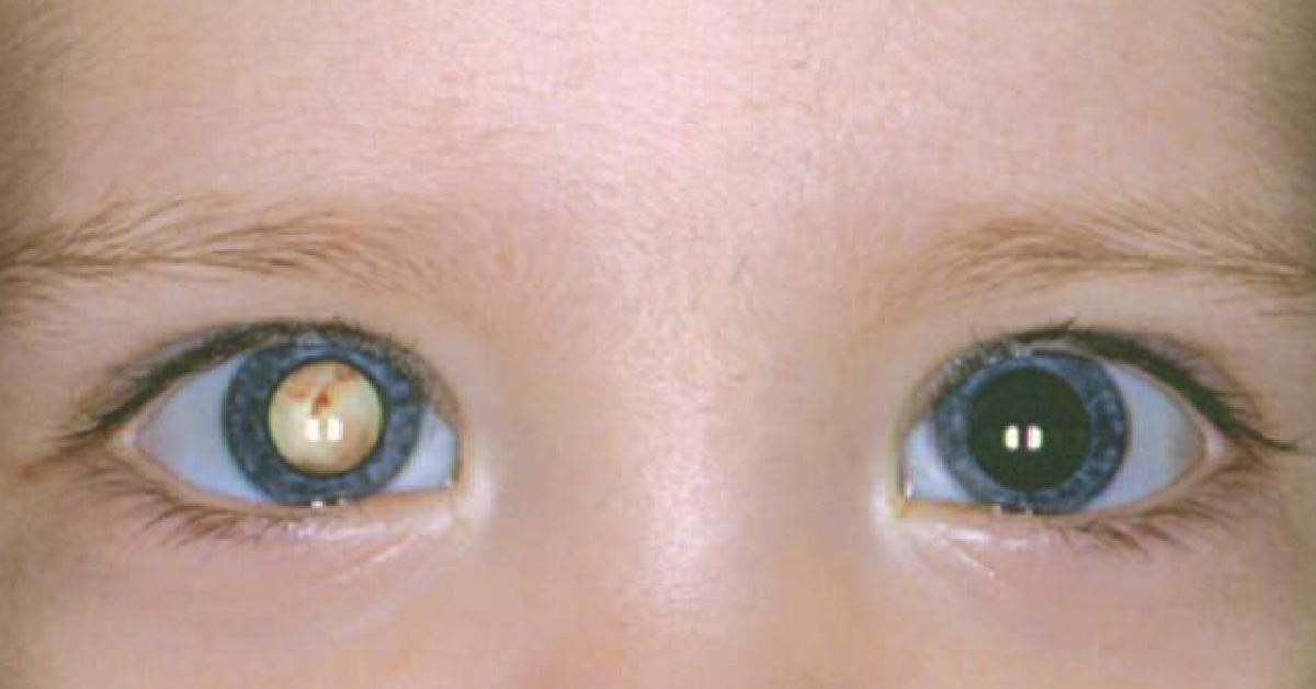 Ocular Manifestations Of Measles
