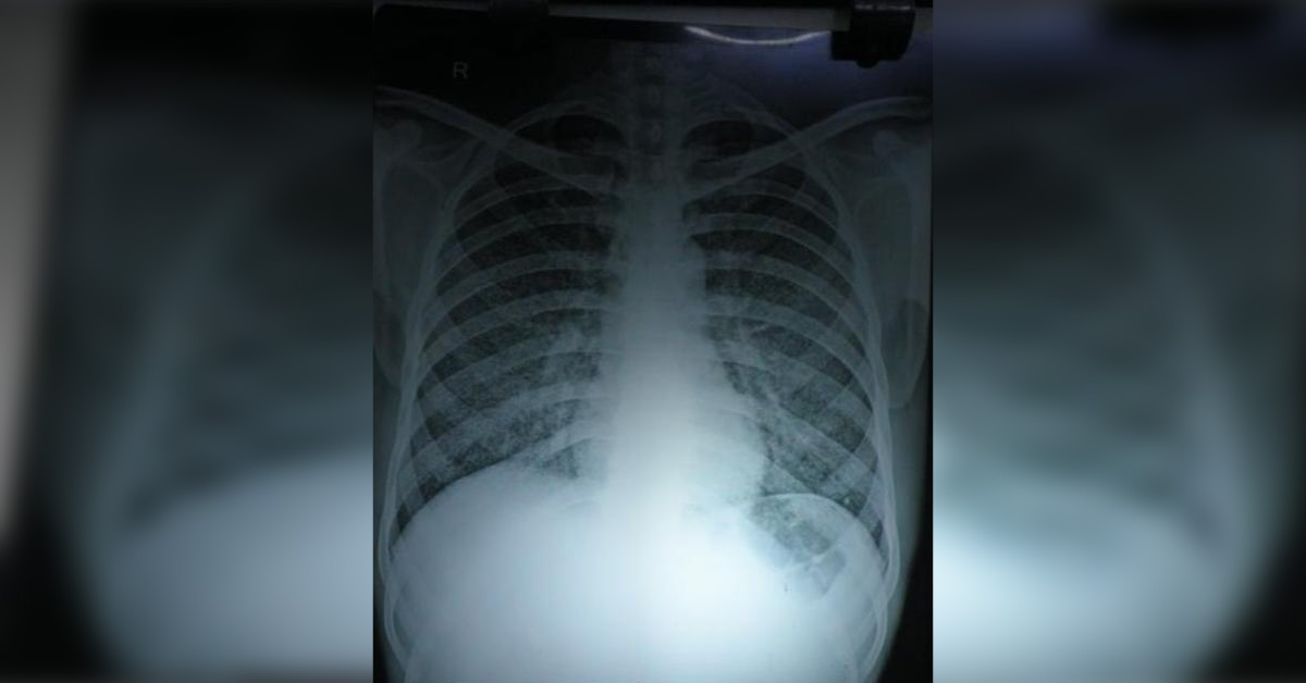 Identify The Findings Of X-ray Chest PA View