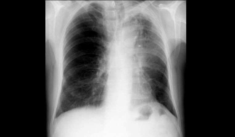 Pulmonary Spot Diagnosis