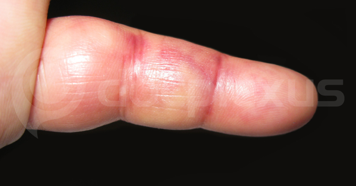 Inflammation And Chronic Diseases