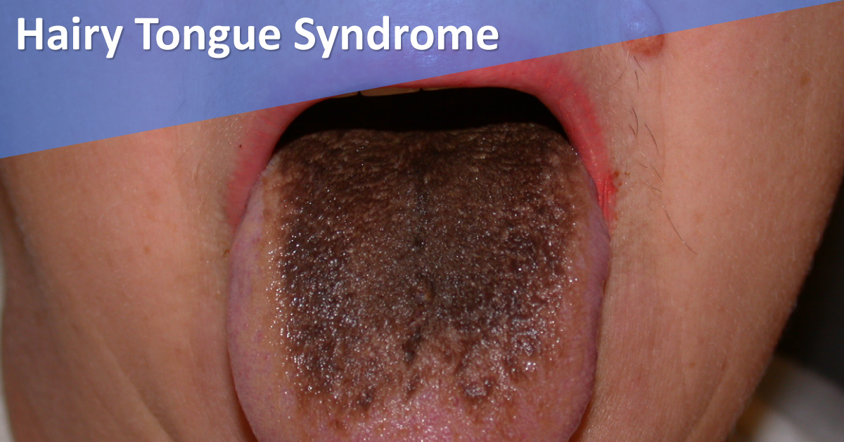 Hairy Tongue: A Buildup Of Filiform Papillae