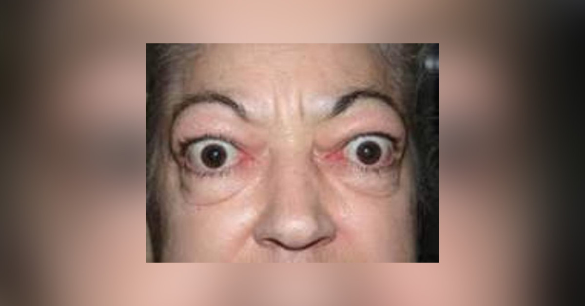 Ocular Manifestations Of Thyrotoxicosis