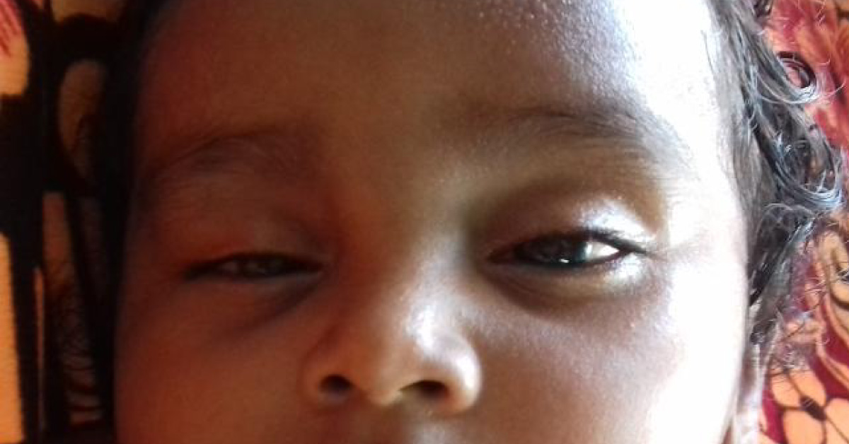 Defective Eye Closure During Sleep