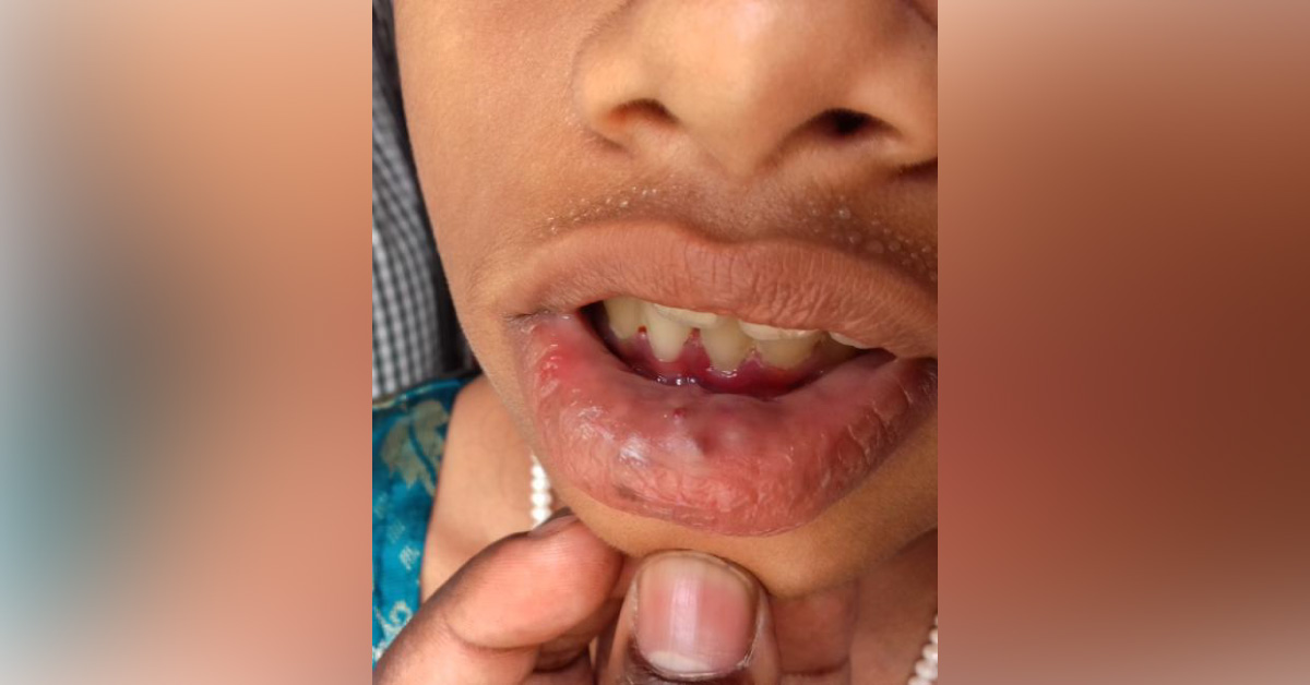 Hemangioma With Verrucous Lesions Over Tongue