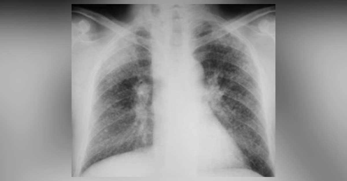 Identify This Pulmonary Condition