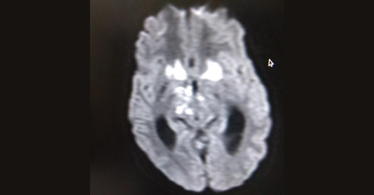 Contrast MRI Of Brain, Identity The Condition