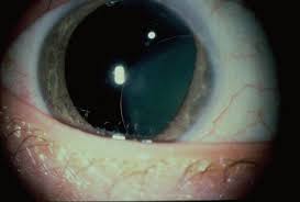 Ocular Manifestations Of Homocystinuria A Brief Review