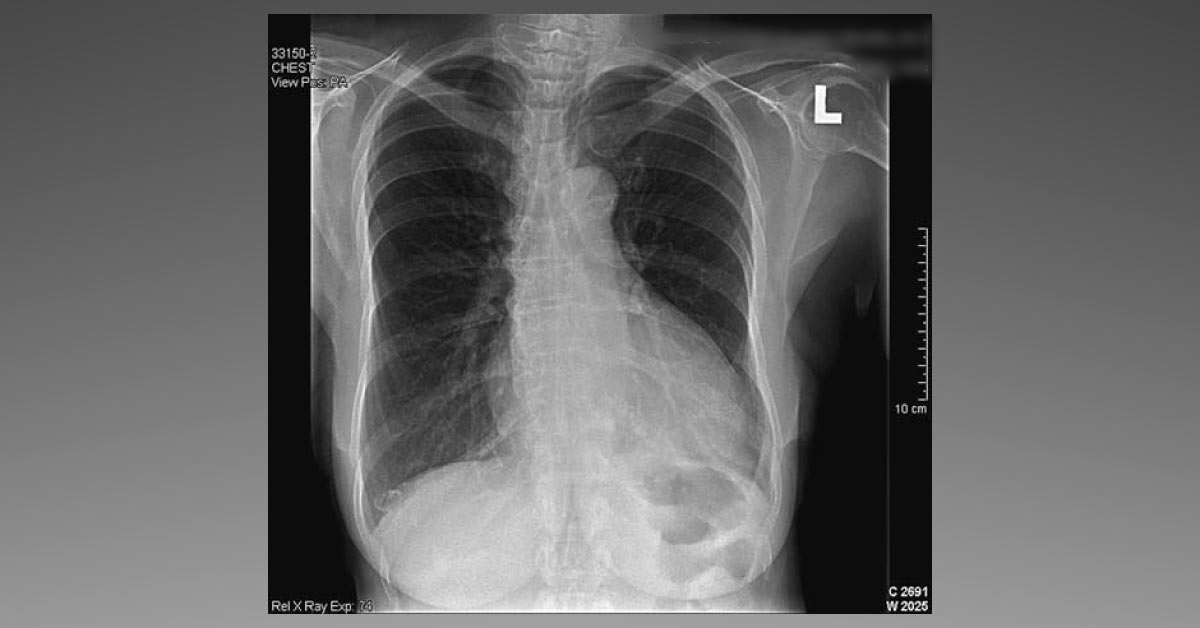 Shortness Of Breath On Exertion