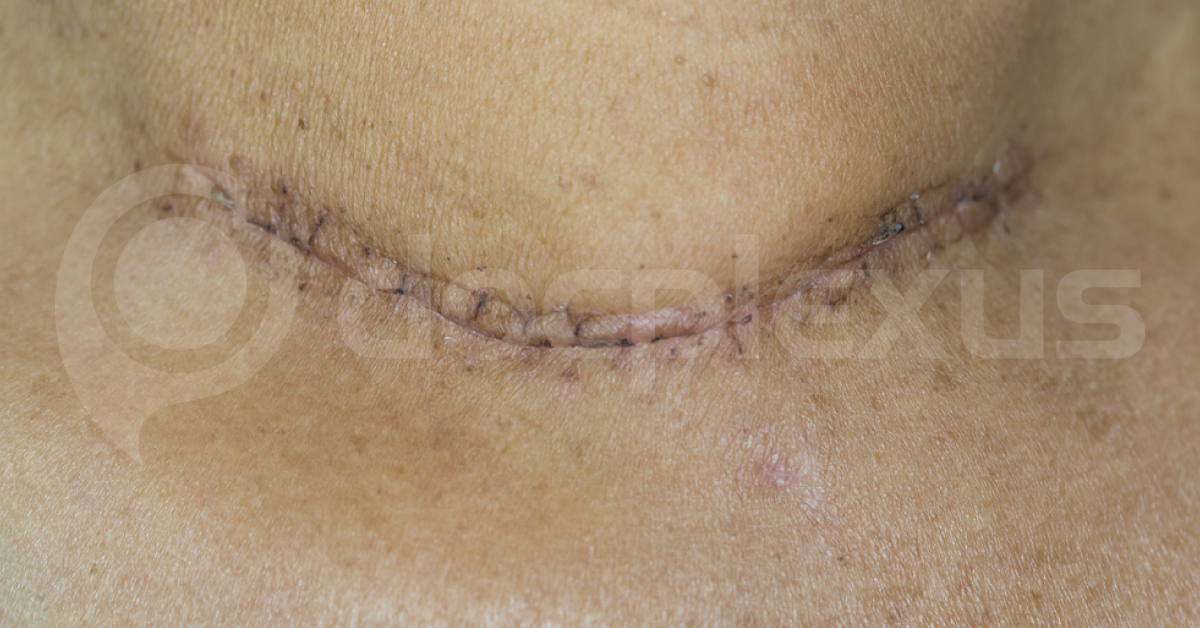 Improving Voice Output After Thyroid Surgery: American Academy Of Otolaryngology