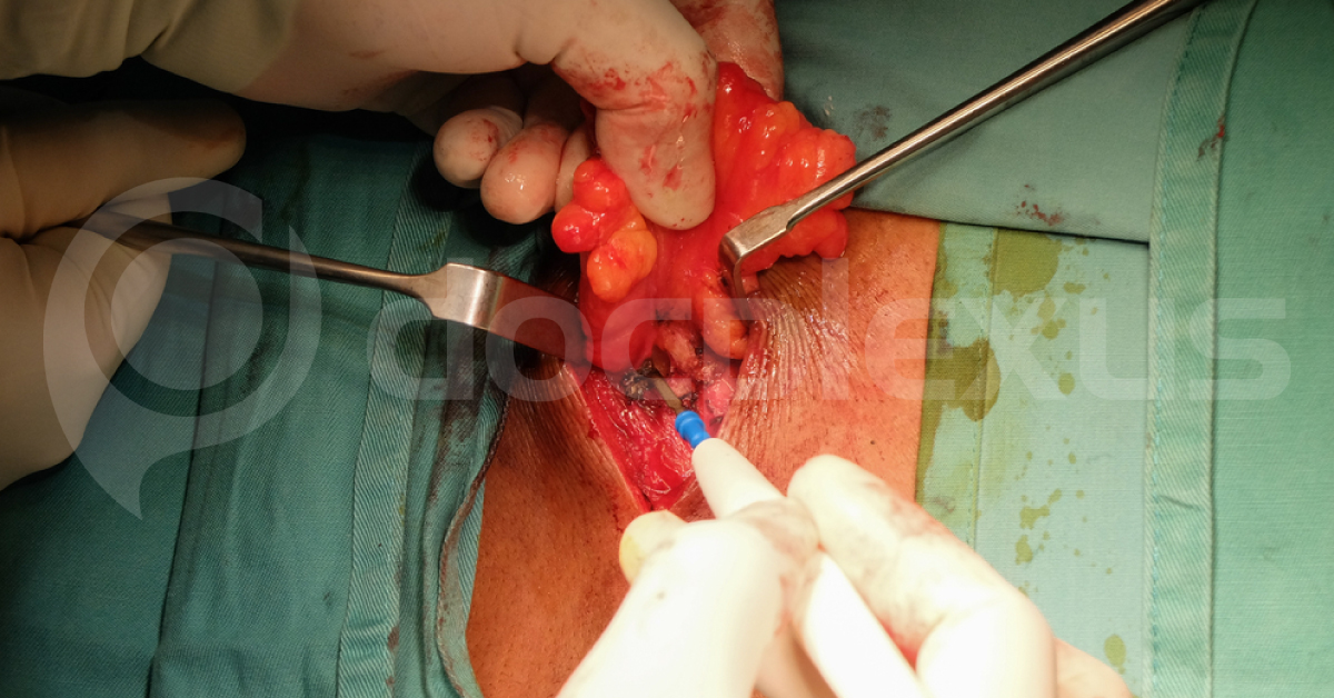 It Is Now Possible To Scan 3D Tumor During Surgery