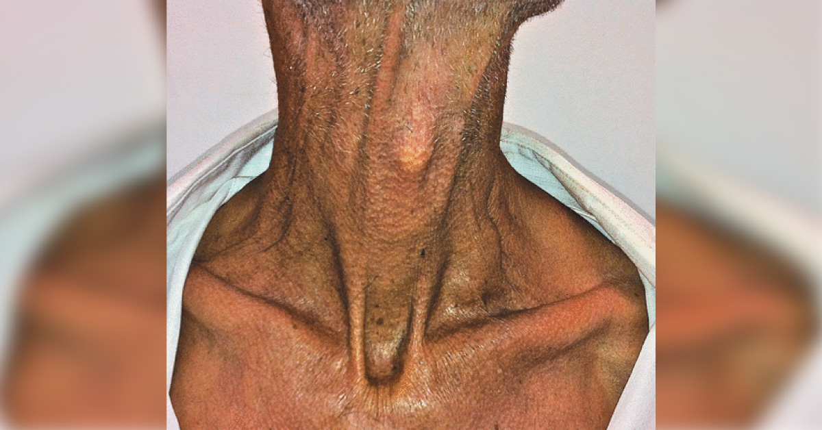 Virchows Sign, Which Carcinoma Is This