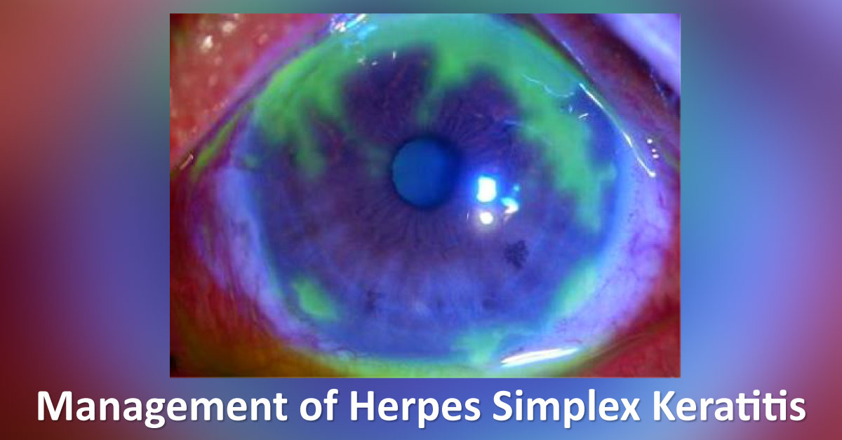 Overview Of Herpes Simplex Keratitis