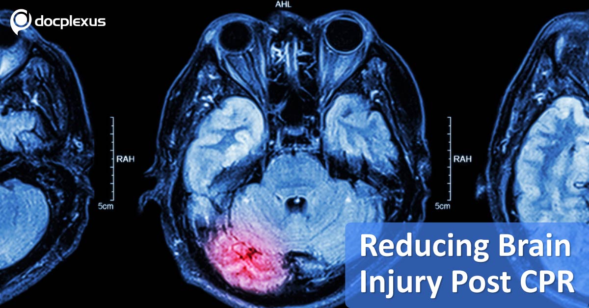 Reducing Brain Injury Post CPR: American Academy of Neurology (2017)