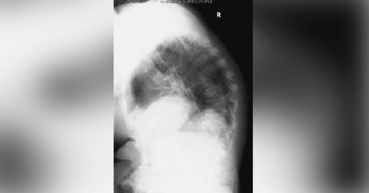 Solve This Interesting Case Of Acute Back Pain