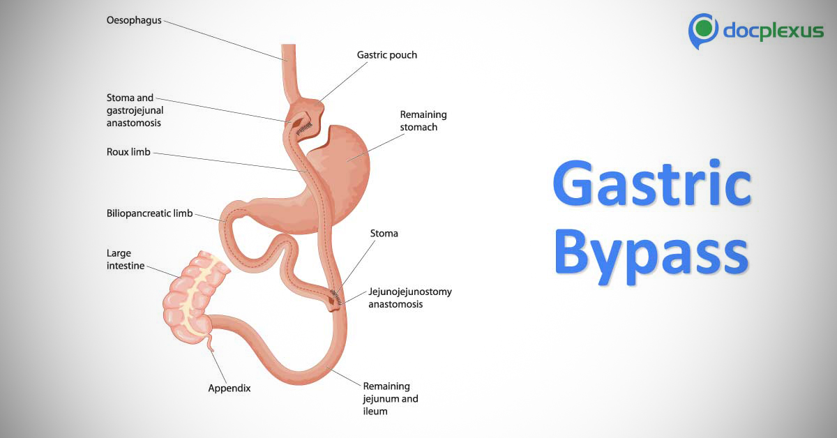 High Rate Of Secondary Hyperparathyroidism After Gastric Bypass Surgery