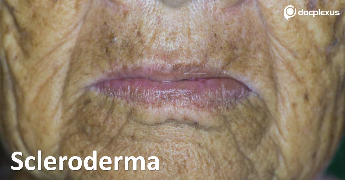 Scleroderma: Drug Treatment Guide to Rheumatologists
