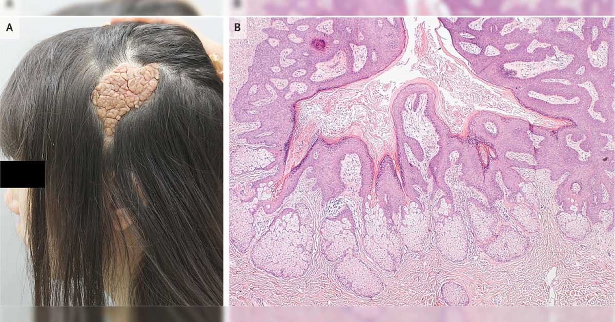 Case Of Congenital Plaque In Child
