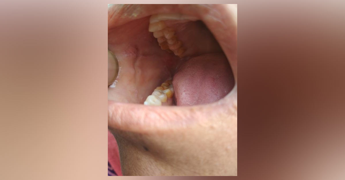 Cause And Treatment For Buccal Side