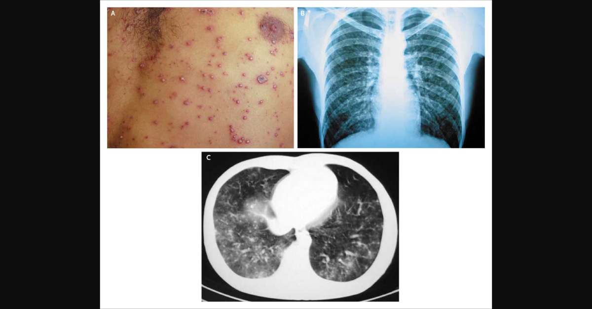 Identify The Reason For Cough, Fever, Rash And Mild Dyspnea