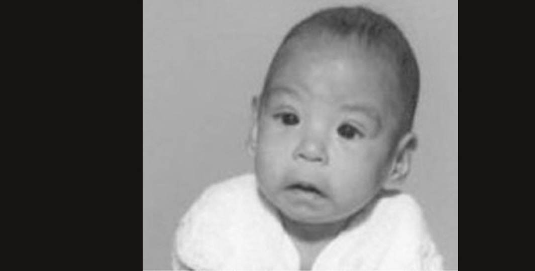 Brief Review On Ocular Manifestations Of Fetal Alcohol Syndrome