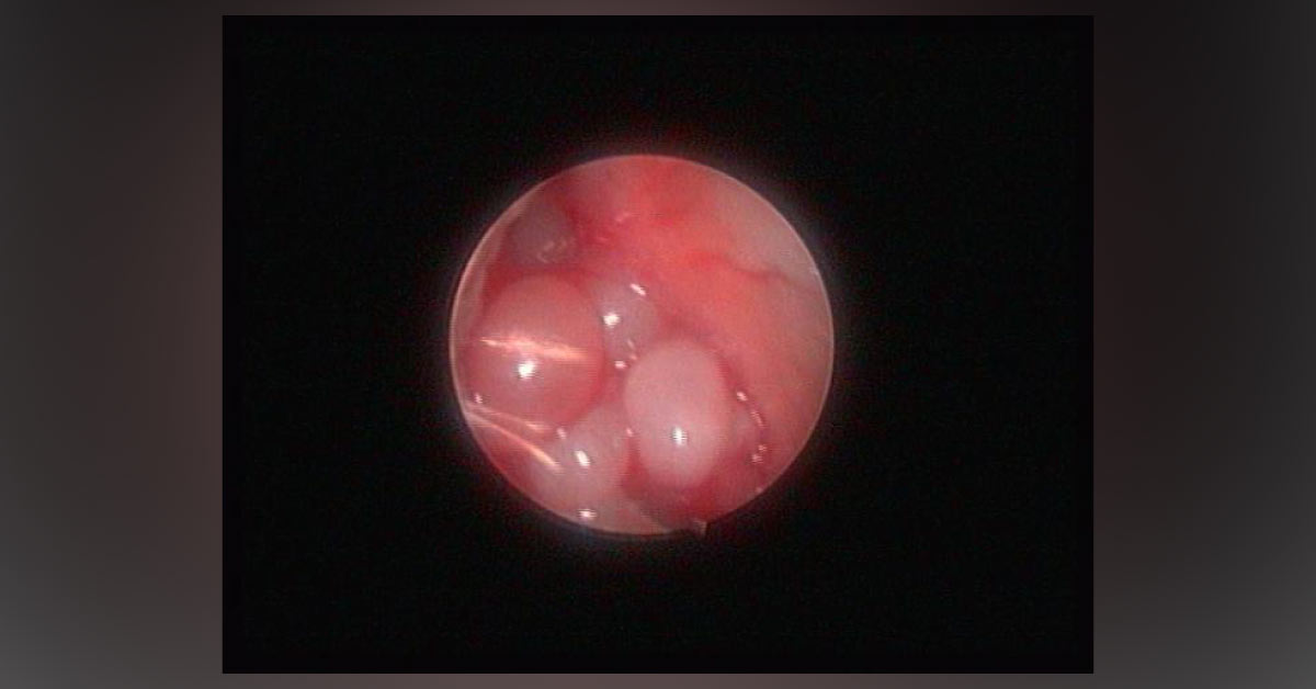 Diagnose This Patient's Right Sided Nasal Problem