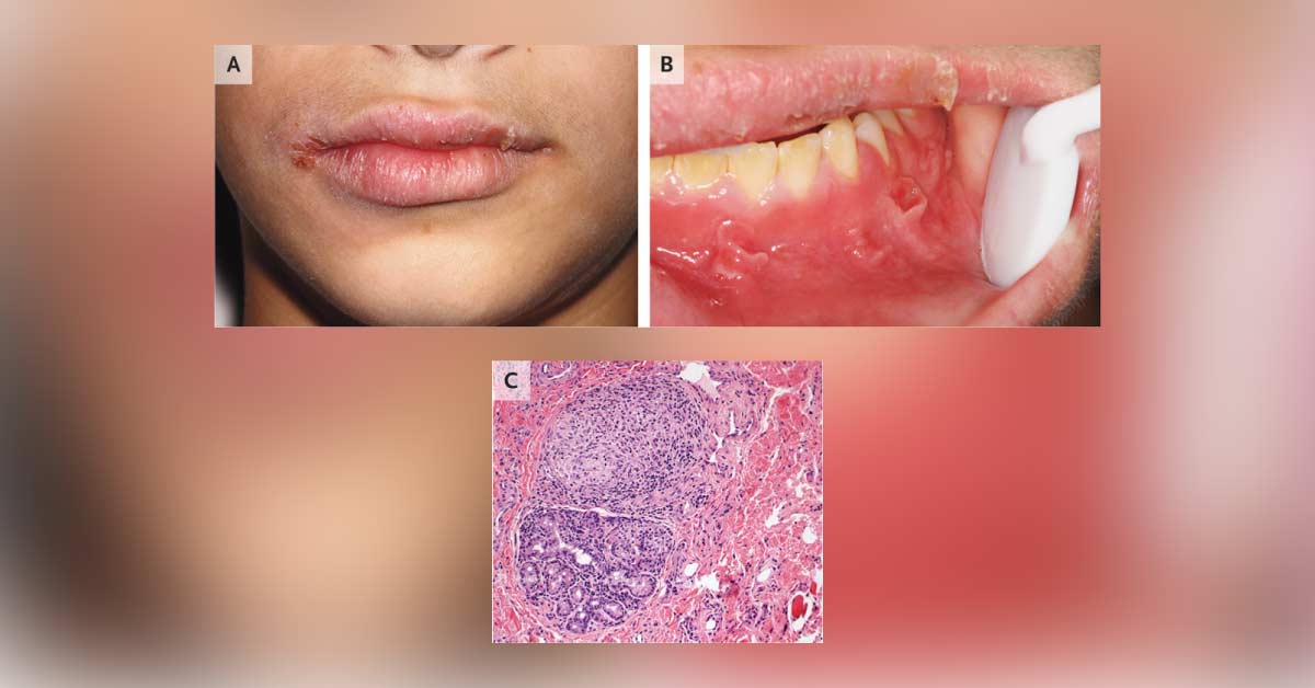 Is It The Oral Manifestation of Crohns Disease