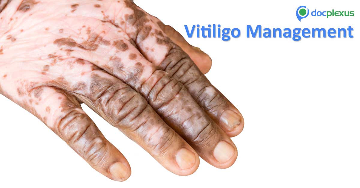 Advances In Vitiligo Management