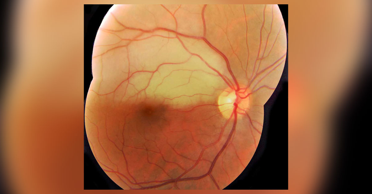Ocular Manifestations Of Systemic Lupus Erythematosus