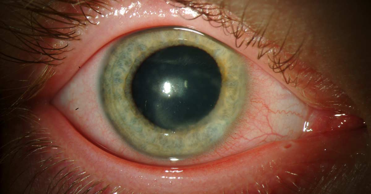Ocular Manifestations Of Herpes Simplex