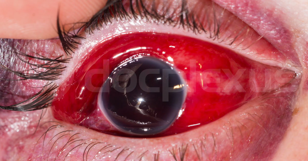 A Man With Hyphemia