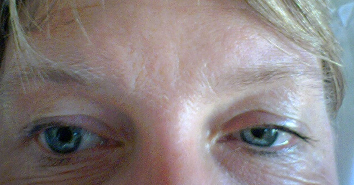 Brief Review On Ocular Manifestations Of Migraine