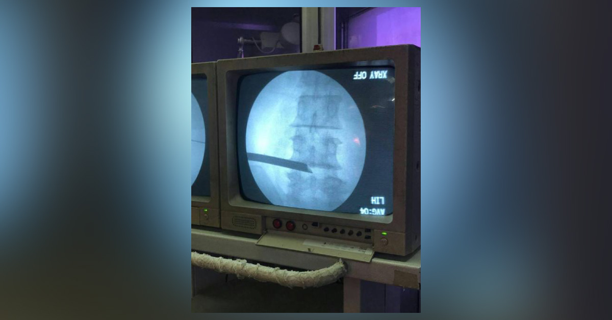 Transforaminal Endoscopic Spine Surgery Under Local Anaesthesia