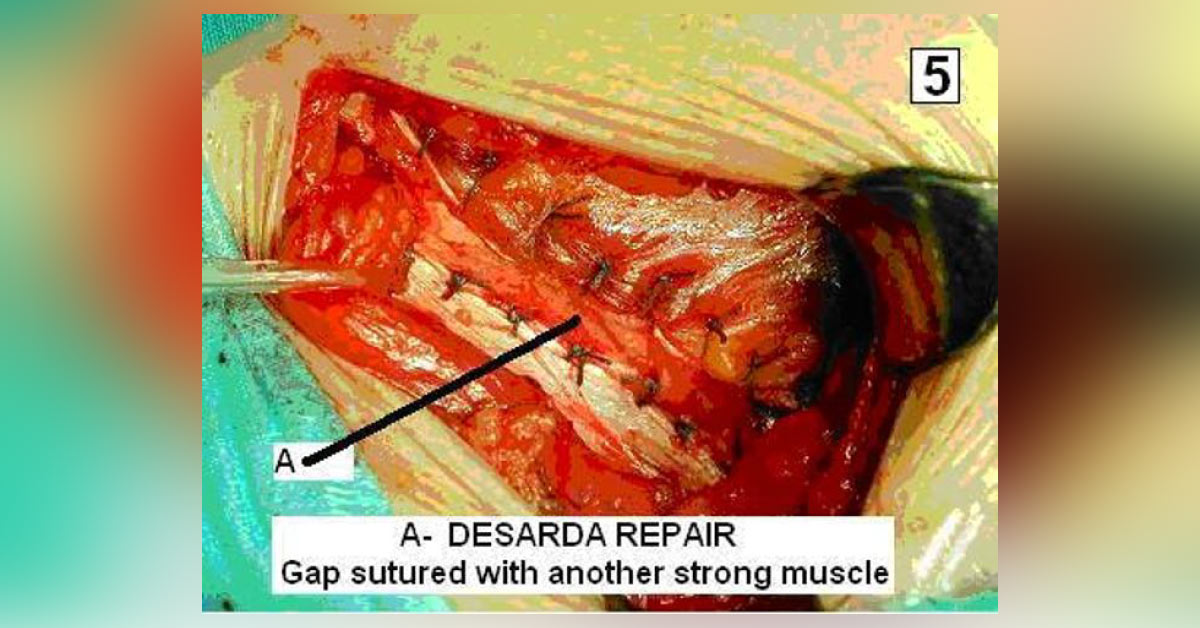 What Is Mesh Used In Hernia Surgery?