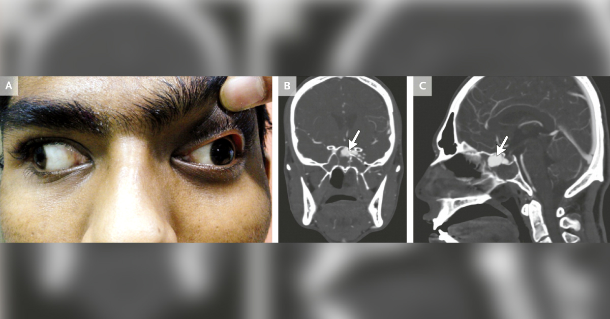 Identify This Condition From Attached CT Images