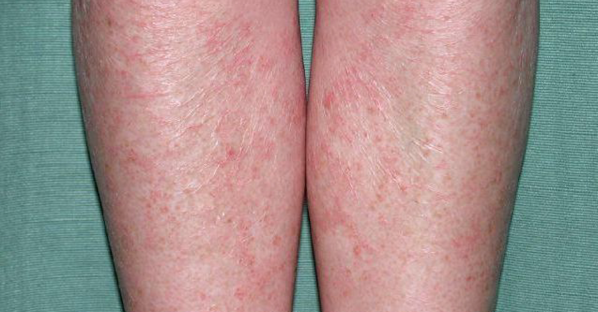 Identify This Dermatology Condition
