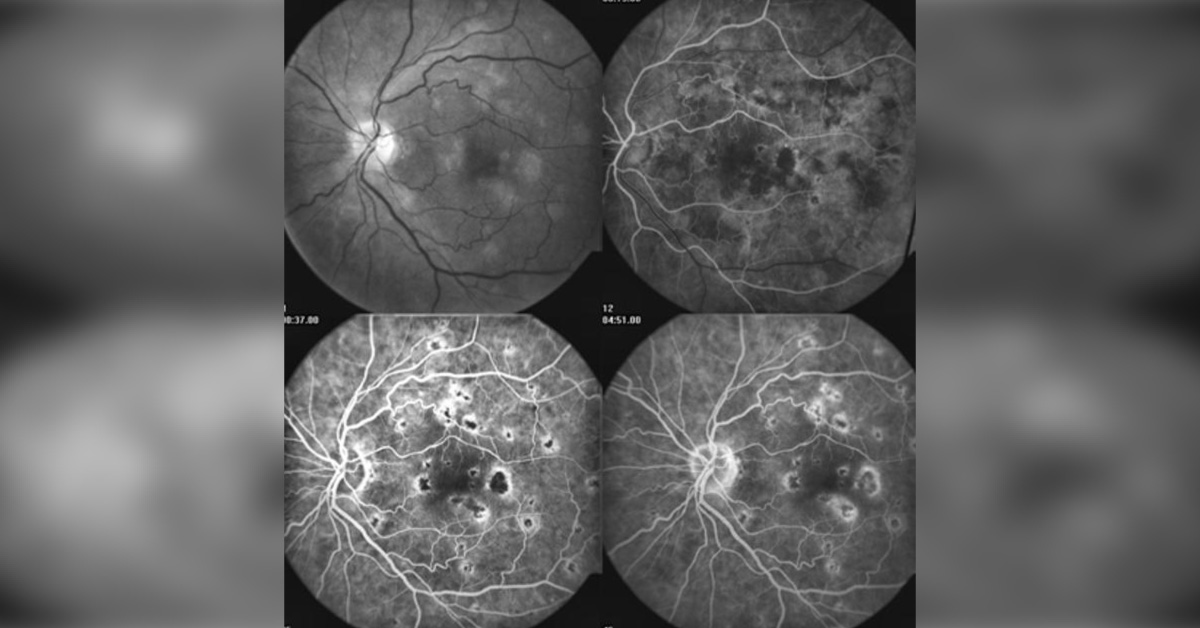 Ocular Manifestations Of CRV Occlusion: A Brief Review