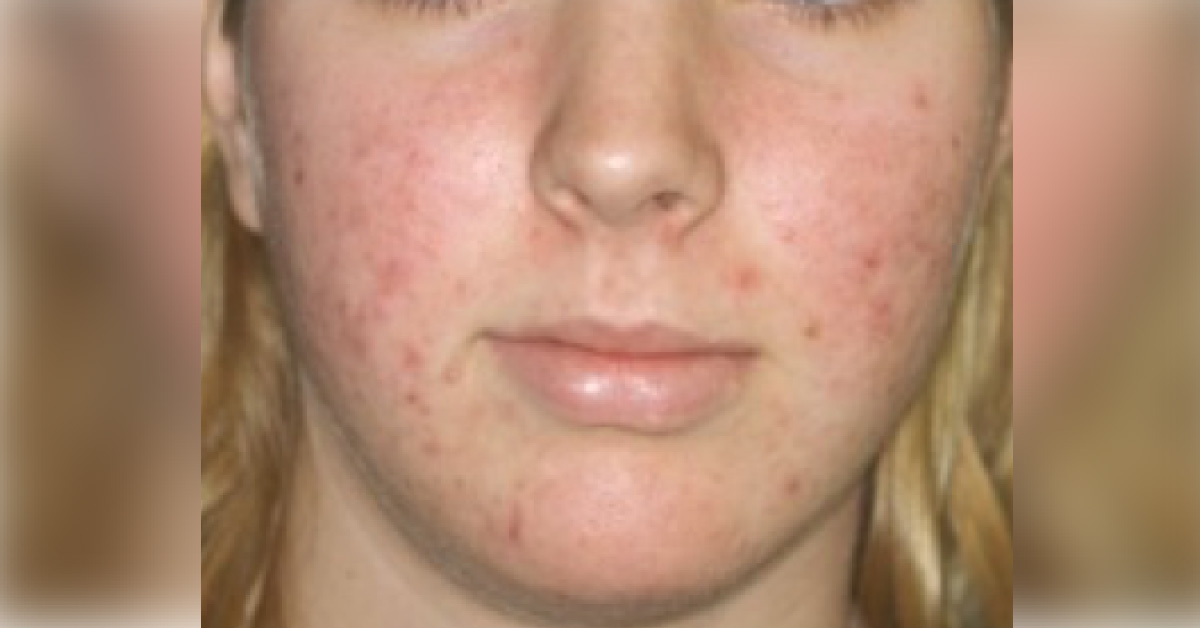 Identify The Dermal Condition