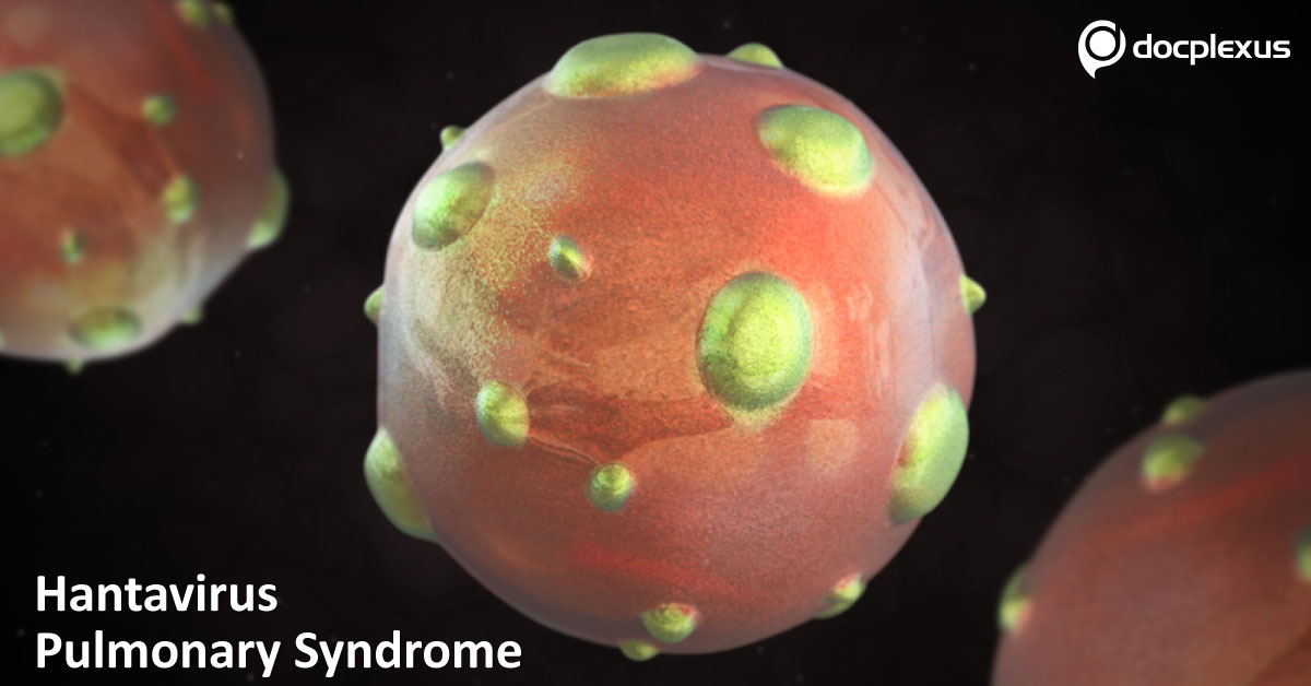 Hantavirus Pulmonary Syndrome (HPS): A Severe Respiratory Disorder