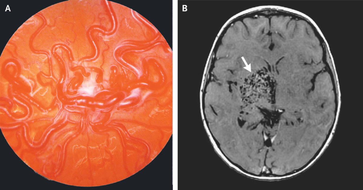 Identify Orbital And Neurological Complication