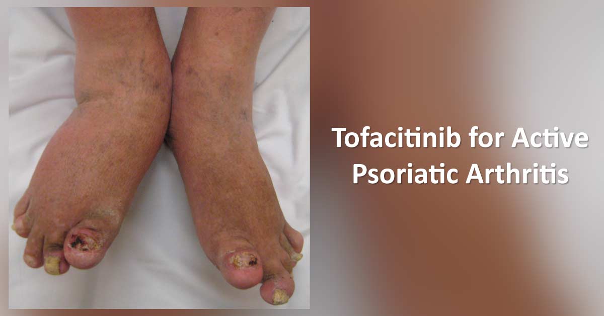 Tofacitinib Approved for Active Psoriatic Arthritis