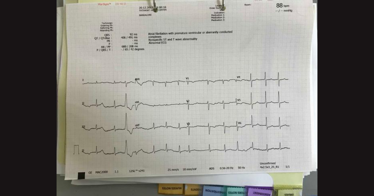 59 Years Old Female Patient With History Of Diabetes Presented With Stroke