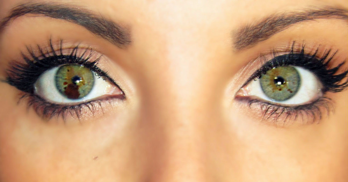 Ocular Manifestations Of Tuberous Sclerosis